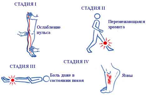 Стадии венозной недостаточности ног