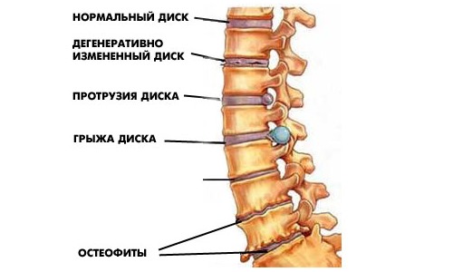 Дегенеративно-дистрофические изменения чаще всго происходят в поясничном отделе