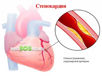 стенокардия