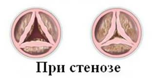 стеноз сердечного клапана