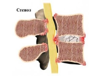 Обратите внимание на симптомы стеноза позвоночника
