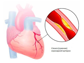 При некоторых сердечных заболеваниях Мелоксикам Прана принимают с осторожностью