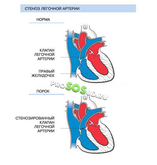 стеноз лёгочной артерии