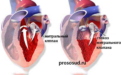 стеноз митрального клапана