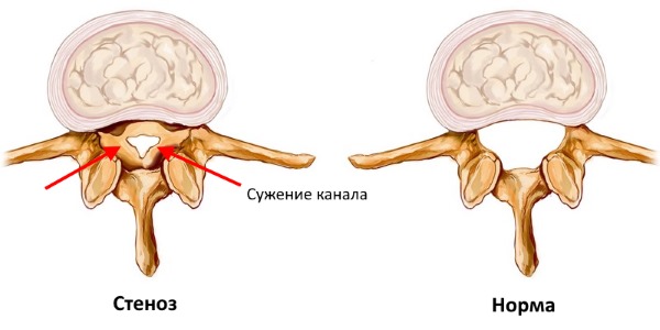 Стеноз характеризуется сужением позвоночного канала