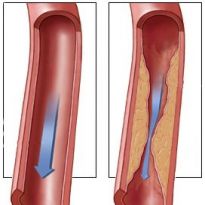 стеноз сосудов
