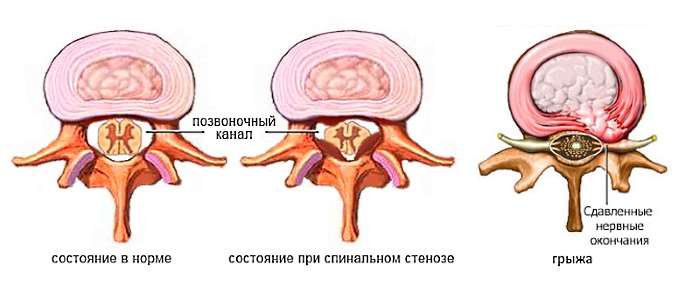 Среди последствий разрастания остеофитов - стеноз канала позвоночника и грыжа