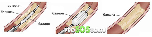 стентирование