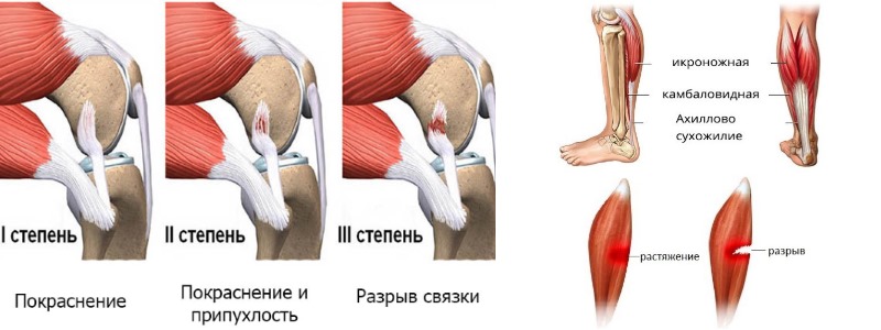 Назначают Фаниган Фаст при различных растяжениях мышц и сухожилий