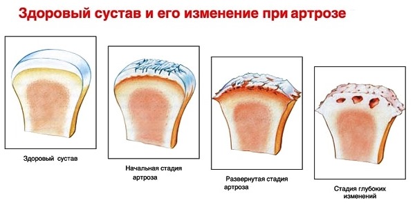 Средство назначают при артрозе, остеохондрозе