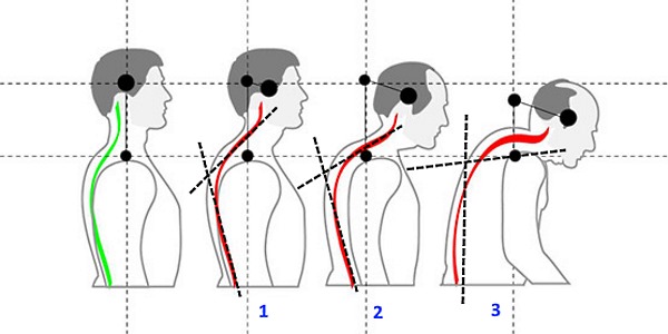 Не всегда при 3 стадии кифоза разрешается делать массаж