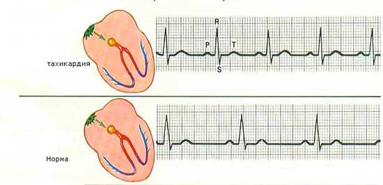 тахикардия