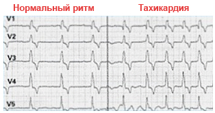 тахикардия