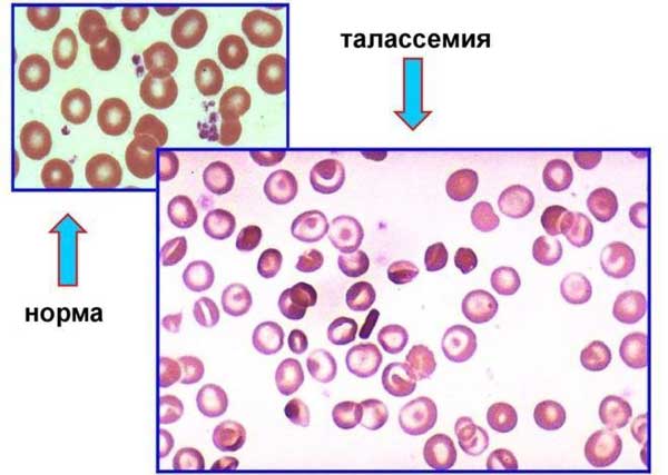 талассамия