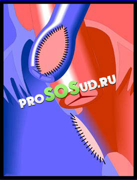 наложение анастомозов