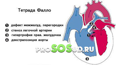 Тетрада Фалло