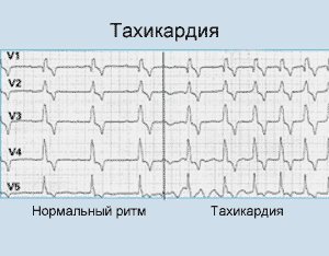 тахикардия
