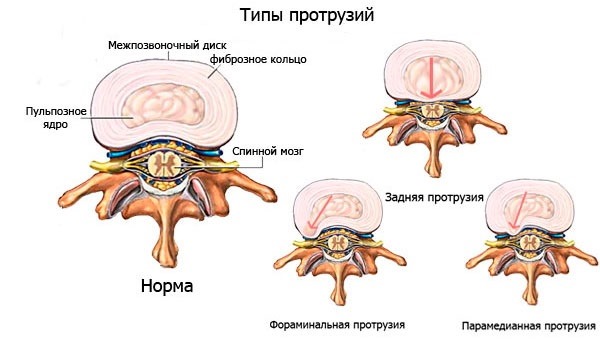 Проявления протрузий зависят от направления выпячивания, при этом заднее считается самым опасным
