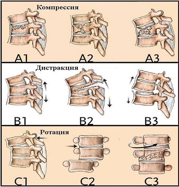 Обратите внимание на виды компрессионного перелома