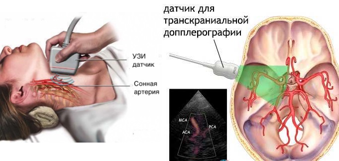 Допплерография позволяет сканировать сосуды с кровотоком