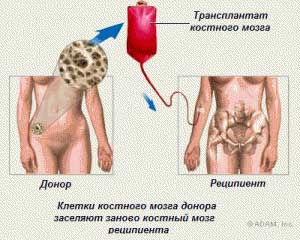трансплантация костного мозга