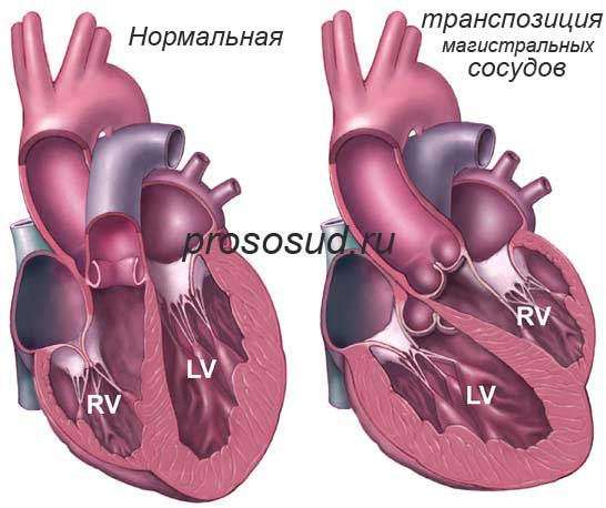 Транспозиция магистральных сосудов схема