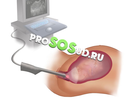 Трансвагинальная эхокардиография