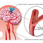 Транзиторная ишемическая атака