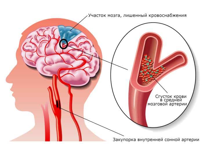 Транзиторная ишемическая атака