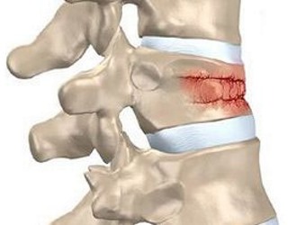 Часто именно травма позвоночника является фактором его деформации