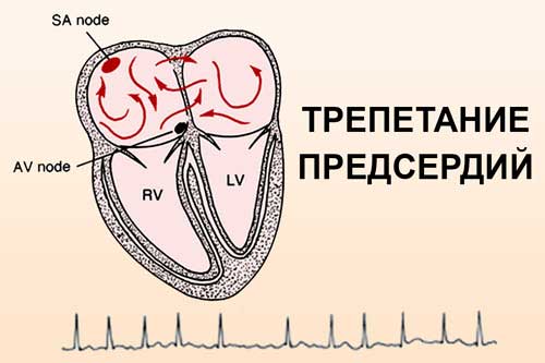 трепетание предсердий