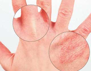 трескается кожа