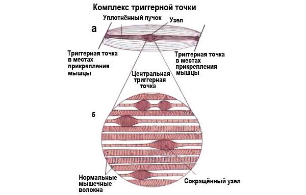 При миофасциальном синдроме в мышечной ткани образуются триггерные точки