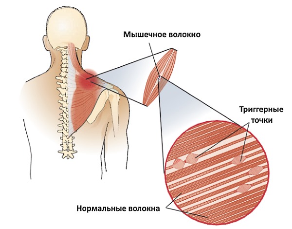 Триггерные точки появляются в любых мышцах спины
