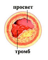 тромб в сосуде