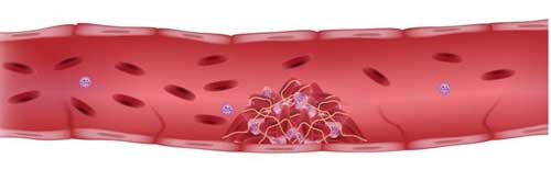 сгусток в вене