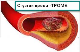 тромб