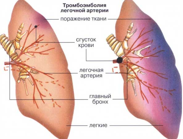 тромбоэмболия легочной артерии