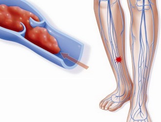 Инъекции средства для суставов запрещено применять при тромбофлебите и других патологиях сердечно-сосудистой системы