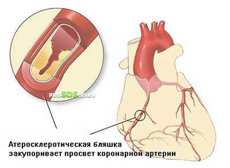 тромбоз коронарных артерий