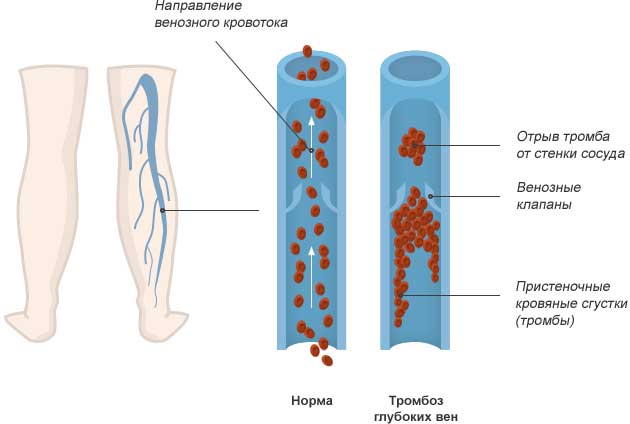 тромбоз глубоких вен