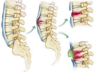Туберкулез костей приводит к гнойному воспалению и разрушению позвонков