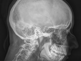 Диагностировать корешковый синдром можно с помощью рентгенографии