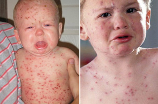 у ребенка красные точки на теле
