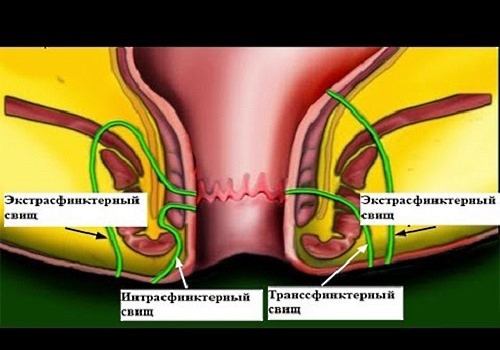 Виды свищей
