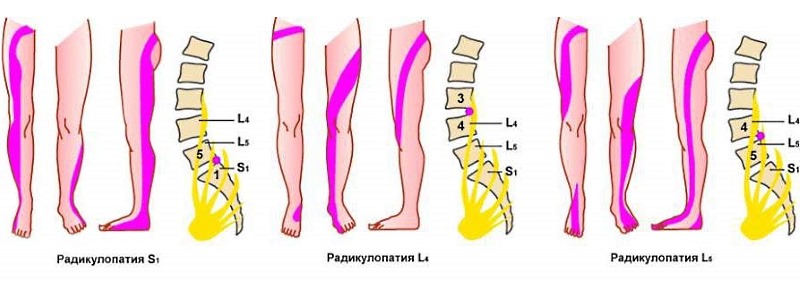 Обратите внимание к каким дисфункциям приводит защемление поясничных корешков