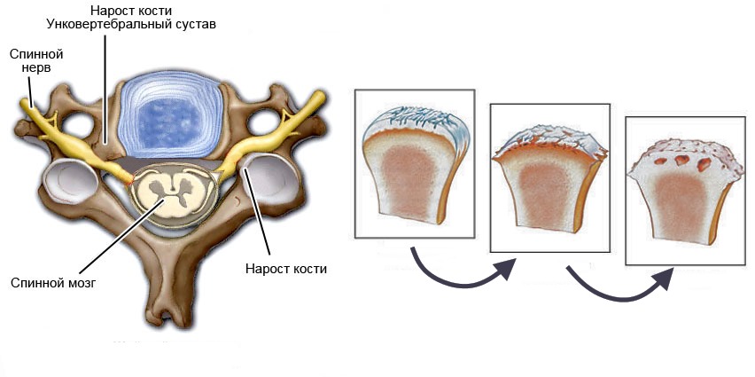 В первое время унковертебральный артроз протекает бессимптомно