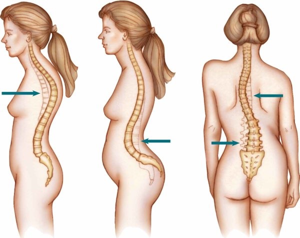 Сколиоз может сопровождаться осложнениями таким как кифоз и лордоз