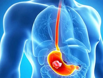 При наличии язвы желудка от приема НПВС нужно отказаться