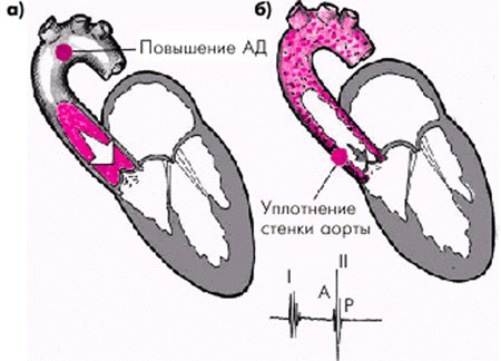уплотнение стенки аорты